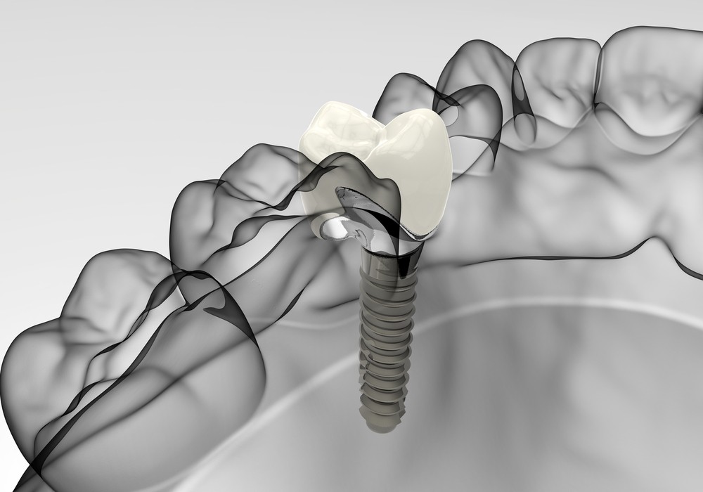 implantologie miercurea-ciuc, implant dentar miercurea-ciuc, clinica stomatologica timea orban