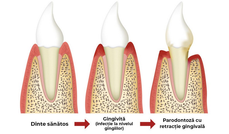 parodontologie miercurea-ciuc, clinica stomatologica timea orban